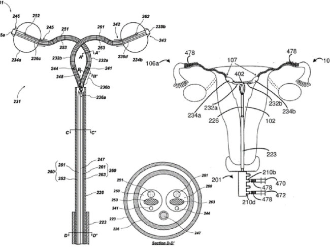 non-surgical contraception